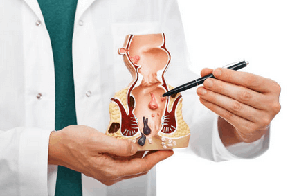 Αιμορροΐδες